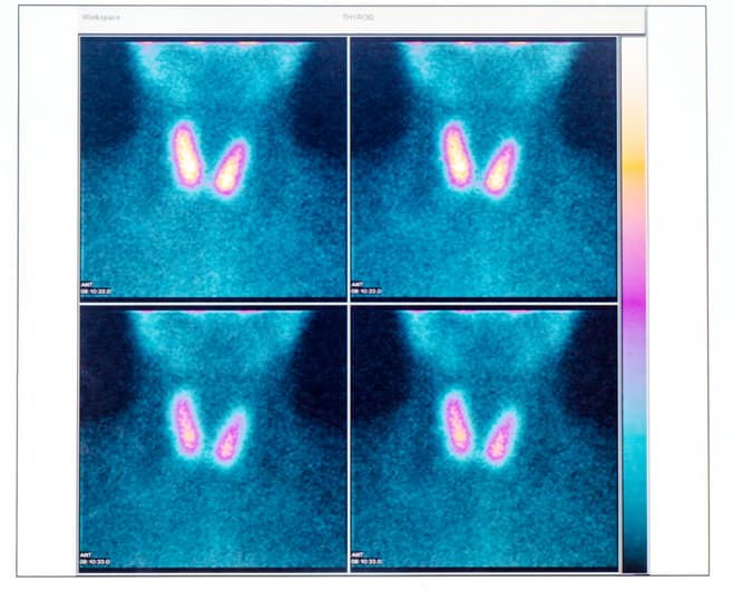 Thyroid Gland Scintigraphy